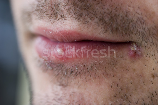 Cold sores (herpes labialis) Stock photo © photohome