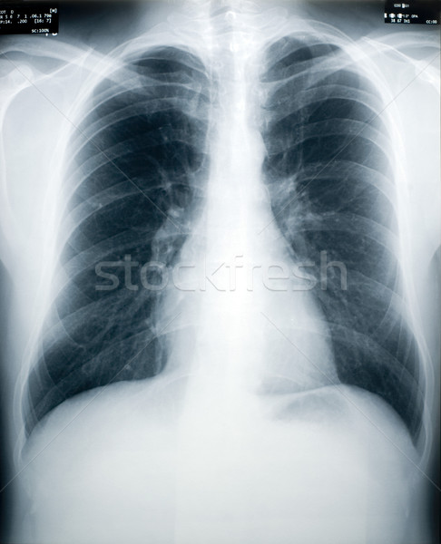 Tuberculosis Screening Stock photo © photohome