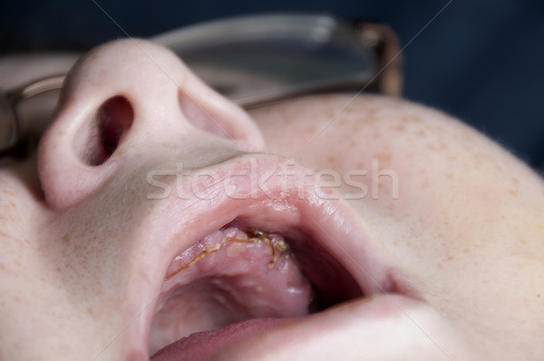 Mündliche Chirurgie Frau alle Zähne Medizin Stock foto © piedmontphoto