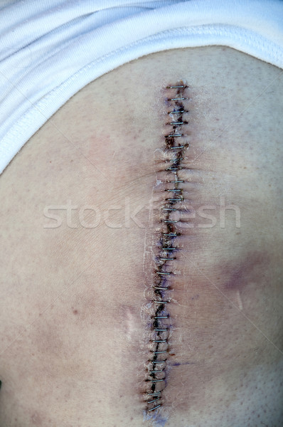 колено замена пациент медицинской здоровья ухода Сток-фото © piedmontphoto
