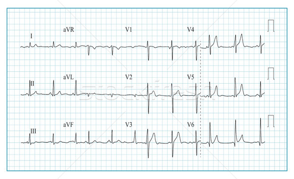 Heart Cardiogram Chart Vector. Illustration Of Wave Form On Checked Ecg Graph. Heart Rhythm, Ischemi Stock photo © pikepicture