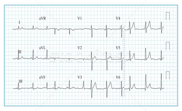 Corazón cardiograma tabla ola forma Foto stock © pikepicture