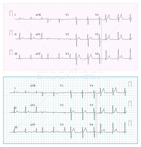 Heart Cardiogram Chart Vector. Set Healthy Heart Rhythm, Ischemia, Infarction. Vitality Heartbeat, H Stock photo © pikepicture