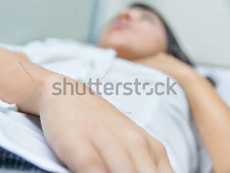 Acupuncture patient with needles along arm Stock photo © pxhidalgo