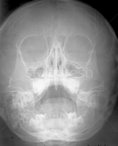 x-ray skull Stock photo © restyler