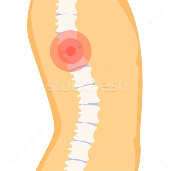 Pain in Human Spine Poster with Red Spot on Bone Stock photo © robuart