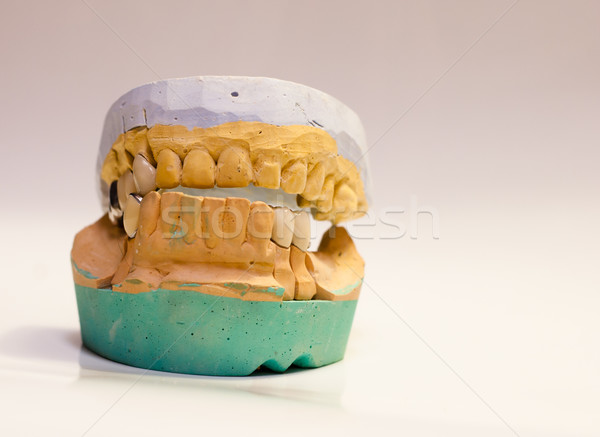 Fogászati implantátum Stock fotó © Sarkao