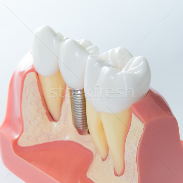 Foto stock: Dentales · implante · modelo · atención · selectiva · tecnología
