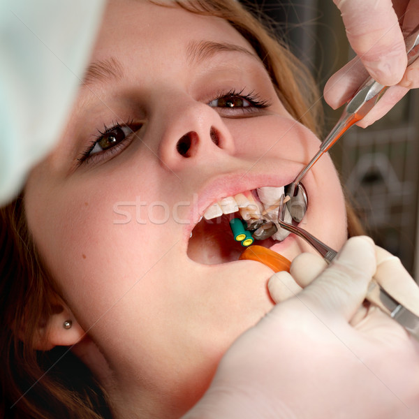 牙科 鑽孔 填充 牙齒 關閉 商業照片 © simazoran