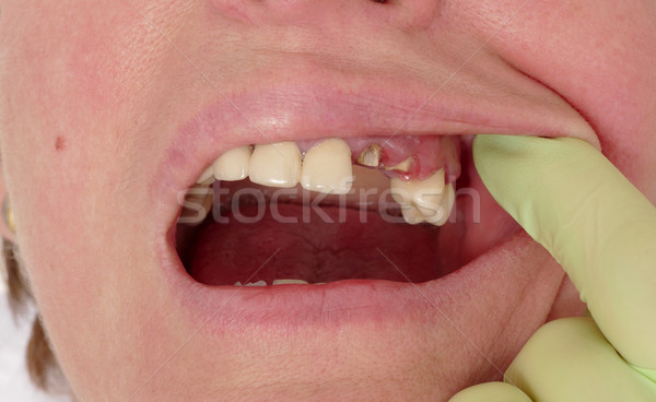 Dental, broken teeth Stock photo © simazoran