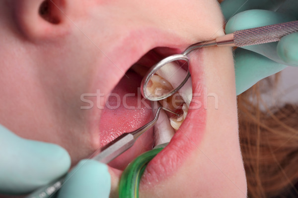 Dentaires dents remplissage trou [[stock_photo]] © simazoran