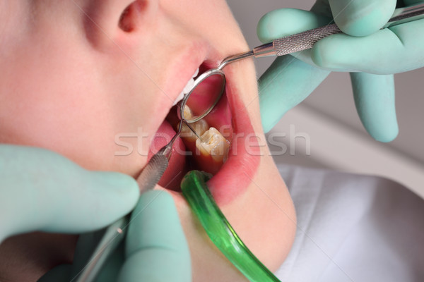 Tandheelkundige procedure tand vulling gat Stockfoto © simazoran