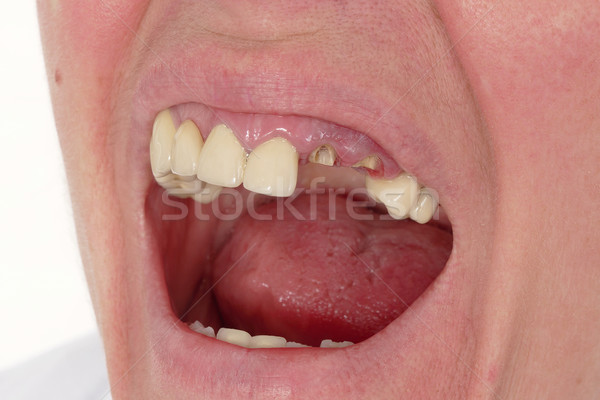 [[stock_photo]]: Dentaires · brisé · dents · artificielle · dents