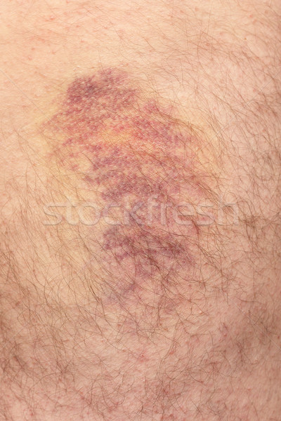 Bruise Stock photo © simazoran
