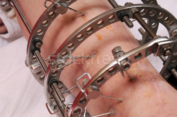 Pierścień utrwalenie ortopedyczny muzyka skóry stali Zdjęcia stock © simazoran