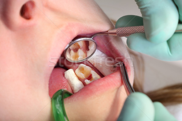 牙科 空穴 關閉 孔 牙齒 鑽孔 商業照片 © simazoran