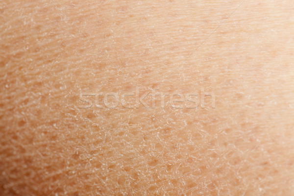 Dry Skin Stock photo © SimpleFoto