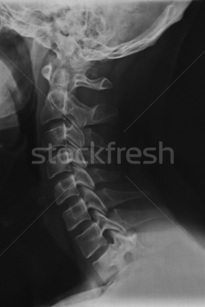 Nyak röntgen scan év öreg felnőtt Stock fotó © sirylok