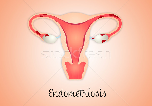 Endometriosis in uterus  Stock photo © sognolucido