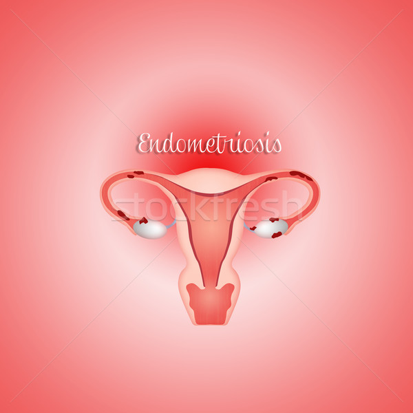 Endometriosis in uterus Stock photo © sognolucido