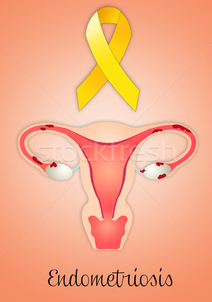 Endometriosis with yellow ribbon Stock photo © sognolucido