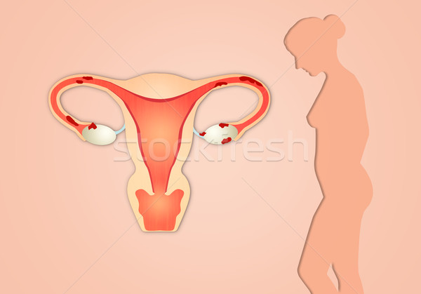 Endometriosis with woman silhouette Stock photo © sognolucido