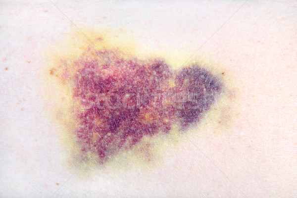 Closeup of a bruise Stock photo © soupstock
