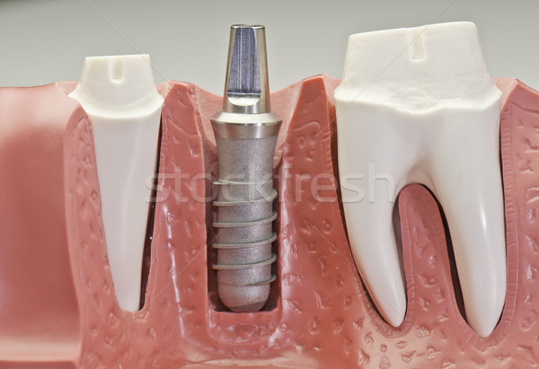 Zahnärztliche Implantat Modell Seite Technologie Stock foto © stockfrank