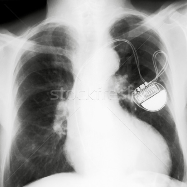 Brust Tempo Medizin Wissenschaft Bildschirm defekt Stock foto © Suljo