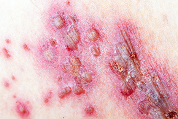 Herpes Zoster (Shingles) Stock photo © supersaiyan3