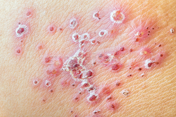 Herpes Zoster (Shingles) - after treatment Stock photo © supersaiyan3