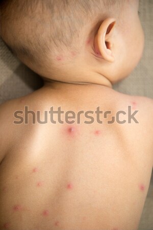 Baby back with chicken pox Stock photo © szefei