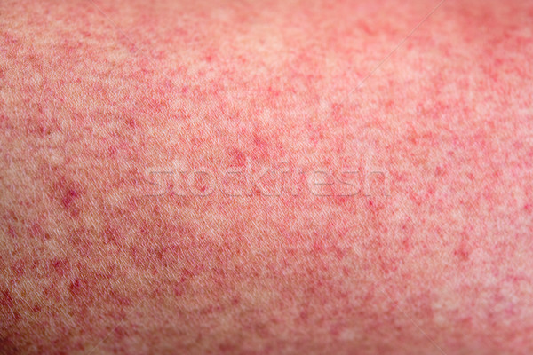 Stock photo: Skin with dengue fever red rashes 