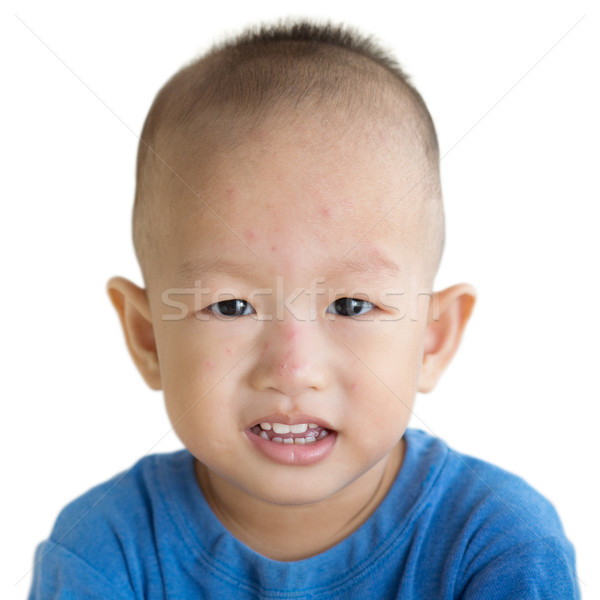 Toddler with red rashes on face Stock photo © szefei