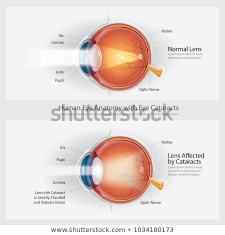 Сток-фото: Cataracts Vision Disorder