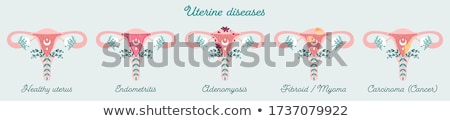 Stockfoto: Uterus And Ovaries Organs Of Female Reproductive System