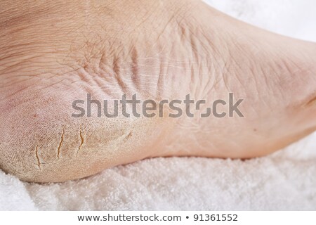 Imagine de stoc: Feet That Need A Pedicure