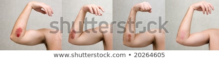 Foto stock: Process Of Wound Healing