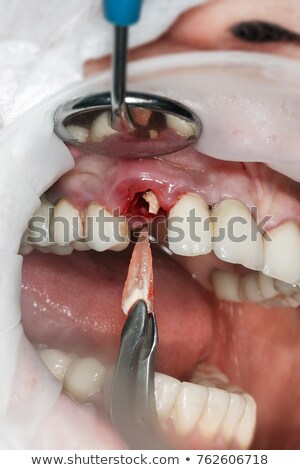 Сток-фото: Dentist Removes Tooth