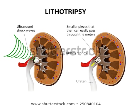 Zdjęcia stock: Lithotripsy In Kidney Stones