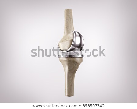 [[stock_photo]]: Components Of A Knee Replacement