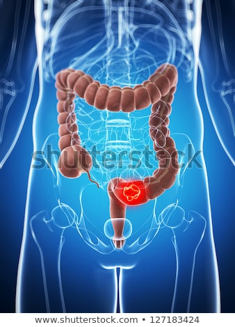 [[stock_photo]]: 3d Rendered Illustration Of The Male Colon - Cancer
