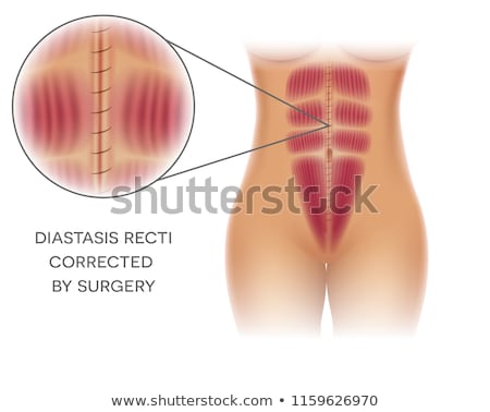 Foto stock: Diastasis Recti Or Abdominal Separation Repair