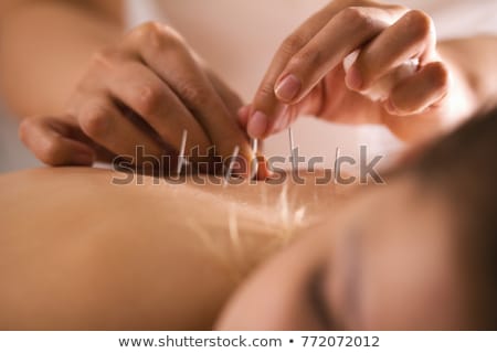 Foto stock: Acupuncture