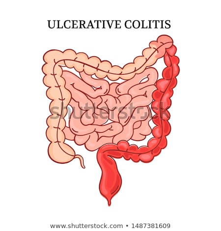 ストックフォト: Human Anatomy Of Ulcerative Colitis