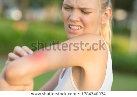 Stok fotoğraf: Insect Bite On Caucasian Skin