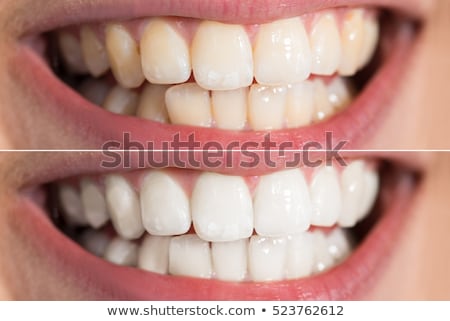 Stock fotó: Womans Teeth Before And After Whitening