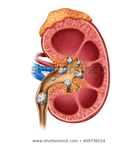 Foto stock: Nephrolithiasis Kidney Stones Disease