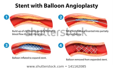 Stockfoto: Balloon Angioplasty