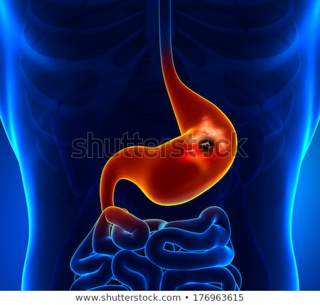 Foto stock: Stomach Ulcer Medical Concept